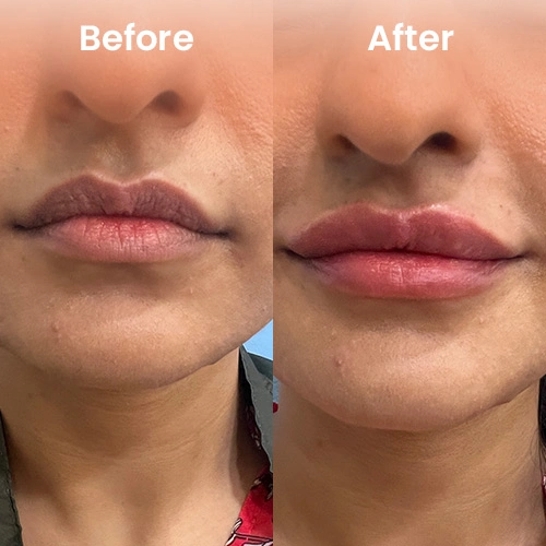 dark-lip-treatment-before-after-1