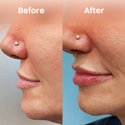 thin-lift-before-after-1